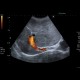 Budd-Chiari syndrome, thrombosis of hepatic veins, liver cirrhosis, TIPSS, splenomegally: US - Ultrasound